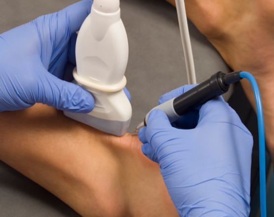 Fysiotherapie_de_Oversteek_Epte_Percutane_Elektrolyse