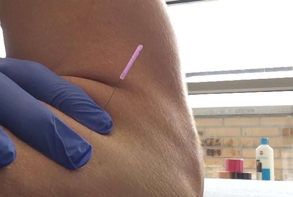 DNS Dry Needling Fysiotherapie de Oversteek Nijmegen Noord Oosterhout pijn rugklachten