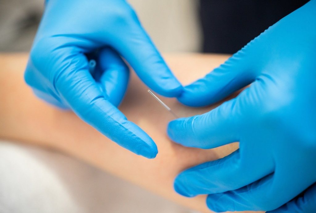Fysiotherapie_de_Oversteek_Dry_Needling_01